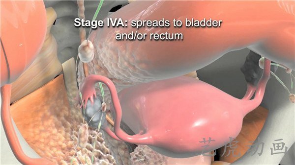 子宮手術(shù)子宮治療子宮疾病子宮三3 子宮手術(shù)子宮治療子宮疾病子宮三3