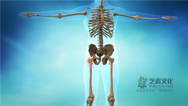 2微創(chuàng)手術(shù)給藥三維動(dòng)畫演示股骨頭[00_00_02][20210220-133844]