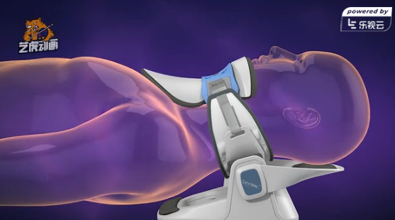 醫療骨折專用器械動畫 醫療骨折專用器械動畫